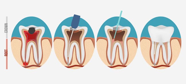 Traitement de canal, Endodontie - étape 1